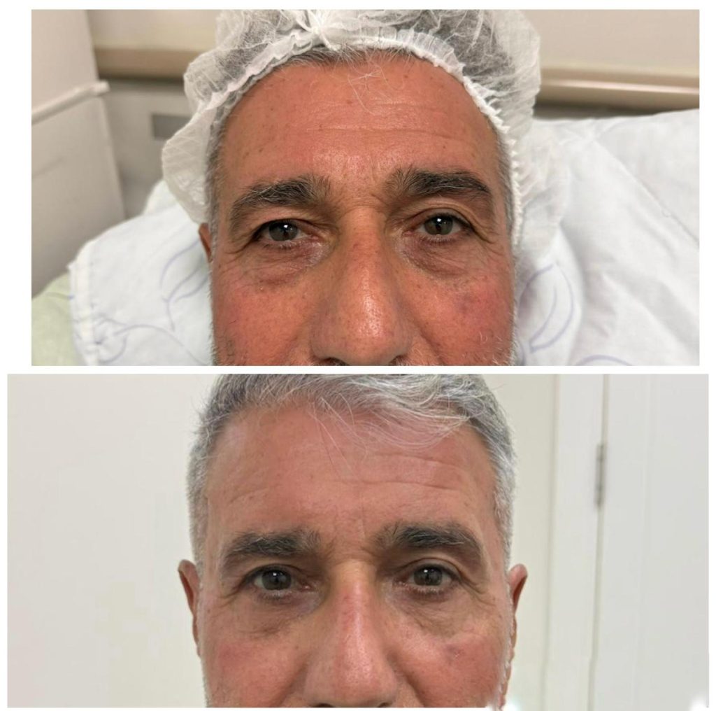 צניחת גבה בעיקר מימין
